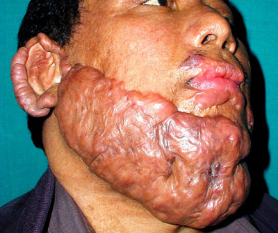 Verbrennungsnarbe_keloid1.jpg