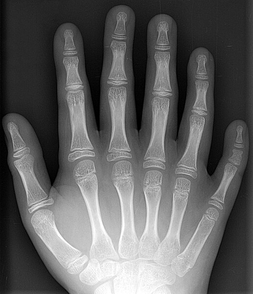 517px-Polydactyly_01_Rhand_AP.jpg