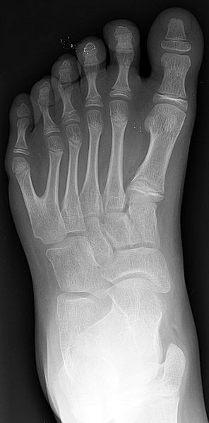 296px-Polydactyly_01_Lfoot_AP.jpg