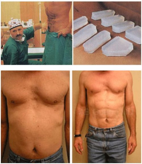 abdominal-implants.jpg